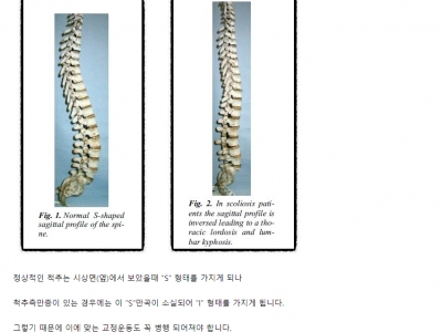 정상 척추의 사상면 척추정렬과 척추측만증 상면 척추정렬 비교