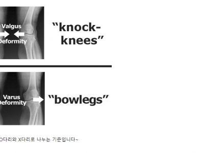 휜다리를 나누는 기준 ~